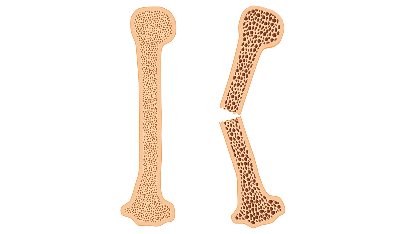 Få en hurtig opdatering på osteoporose Tag Praktisk Medicins e-læringskursus om osteoporose, og bliv opdateret på udredning og behandling. Det tager cirka 10 minutter, og alle svar er anonyme.